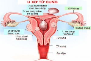 u xơ tử cung là gì