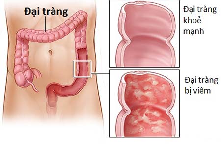 Kotra ĐQ hộp 30 viên - Hỗ trờ giảm viêm đại tràng và ruột kích thích