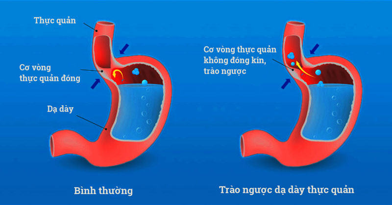 bệnh trào ngược dạ dày