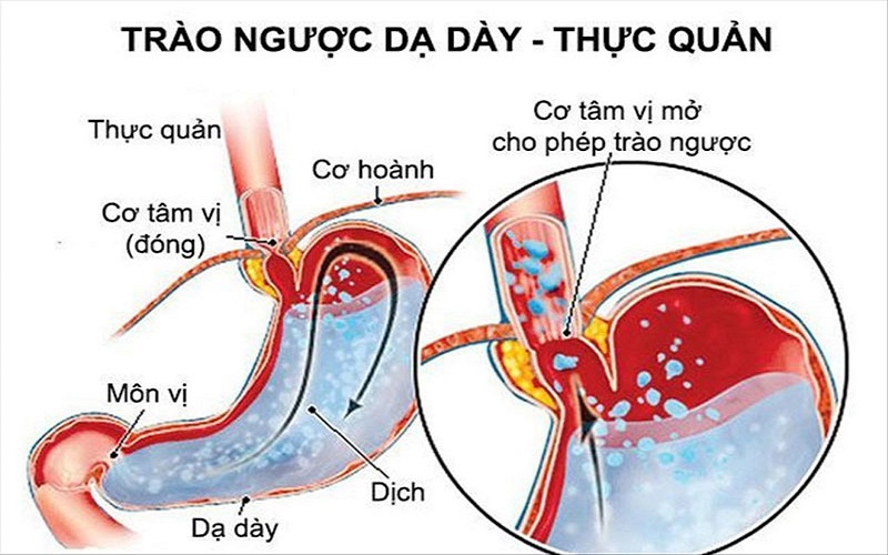 Trào ngược axit dạ dày