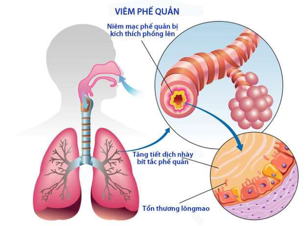 Viêm phế quản là gì?