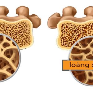 Các phương pháp đo mật độ xương để phát hiện nguy cơ loãng xương