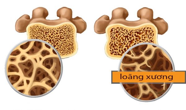 Các phương pháp đo mật độ xương để phát hiện nguy cơ loãng xương