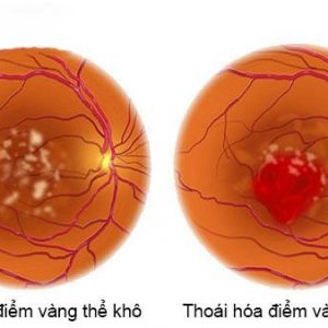 Thoái hóa điểm vàng ở hai dạng thể khô và thể ướt