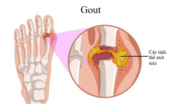 gout