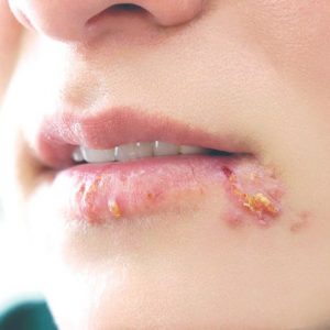 Herpes Simplex