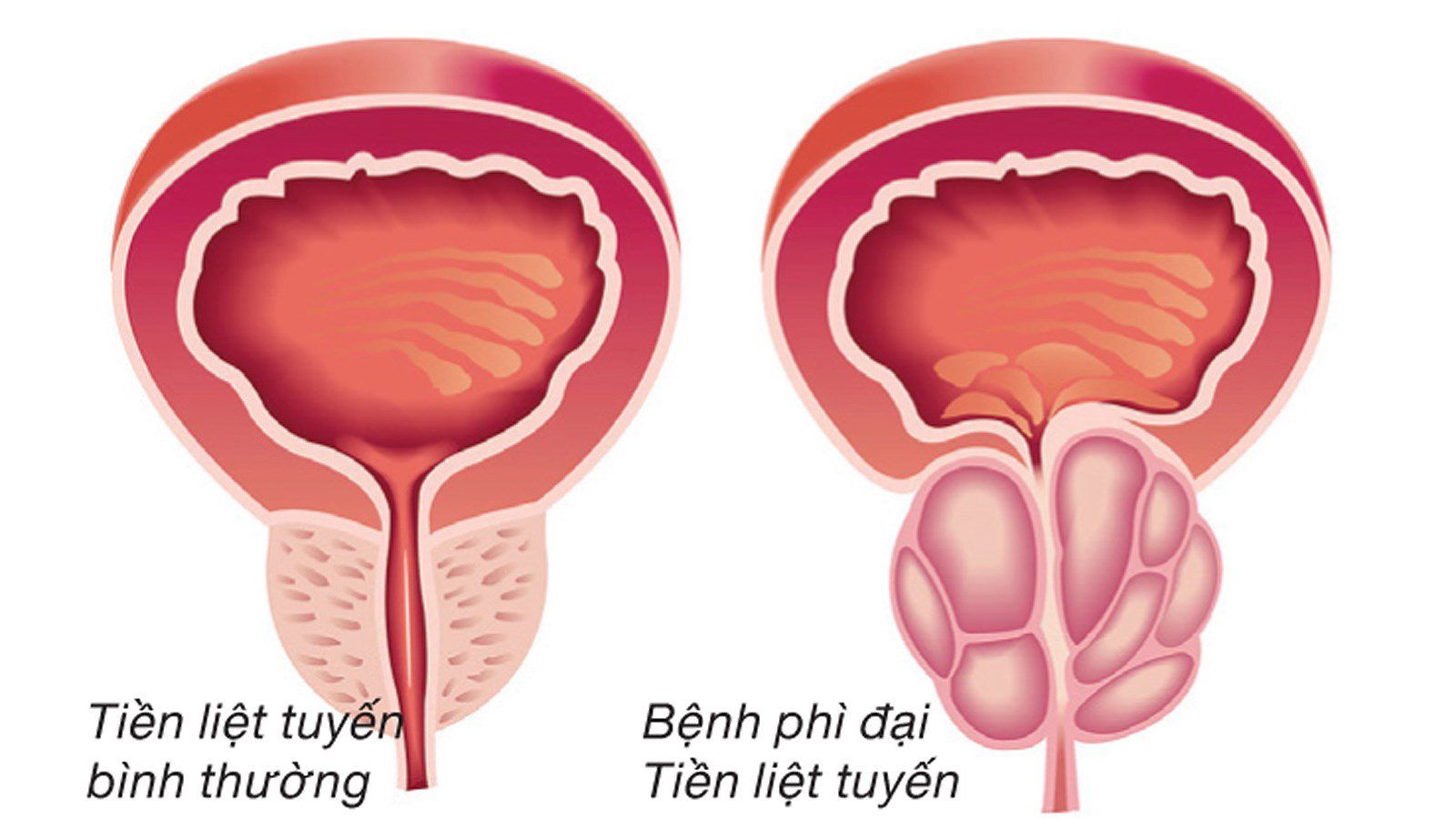 phì đại tuyến tiền liệt