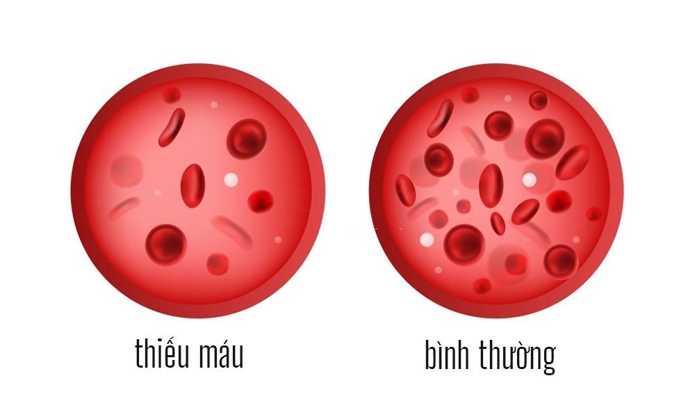 thiếu máu