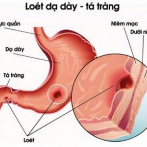 Omevin IV - Điều trị viêm loét dạ dày tá tràng