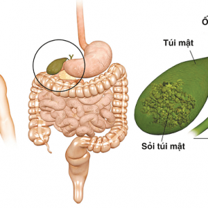 sỏi mật