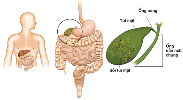 sỏi mật