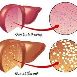 Detoxify Liver Hộp 50 Viên - Gan nhiễm mỡ