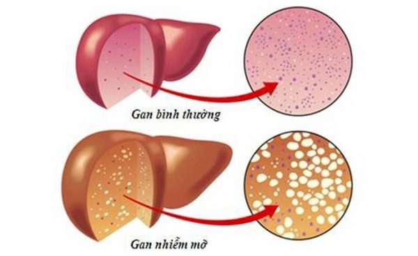 Detoxify Liver Hộp 50 Viên - Gan nhiễm mỡ