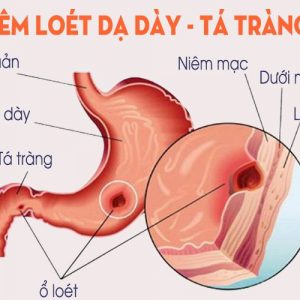 Viêm Loét Dạ Dày , Tá Tràng