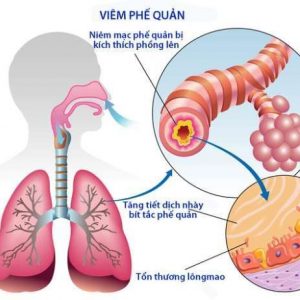 viêm phế quản