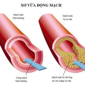 Xơ vữa động mạch